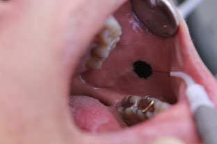 口内炎の治療